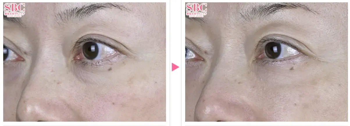 京都でモフィウス8が安いおすすめの湘南クリニック　症例写真