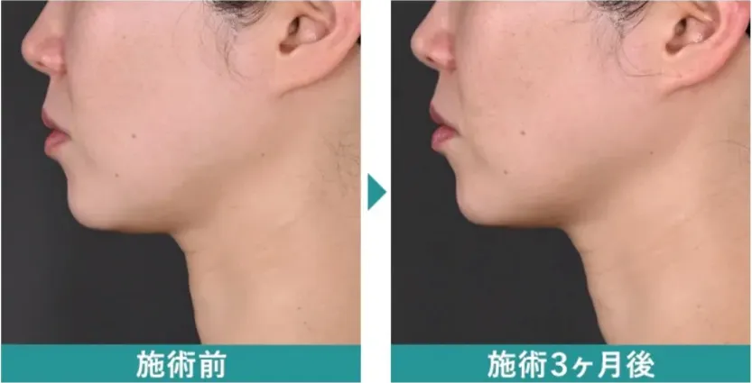 湘南美容クリニックの症例写真 京都 デンシティ 安い おすすめ