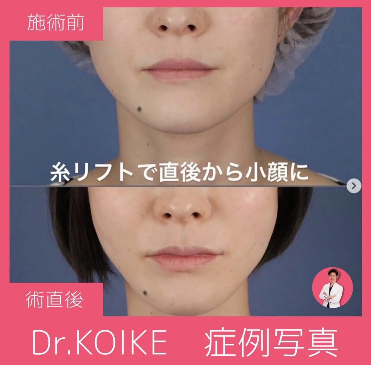 湘南美容クリニックの糸リフト症例①