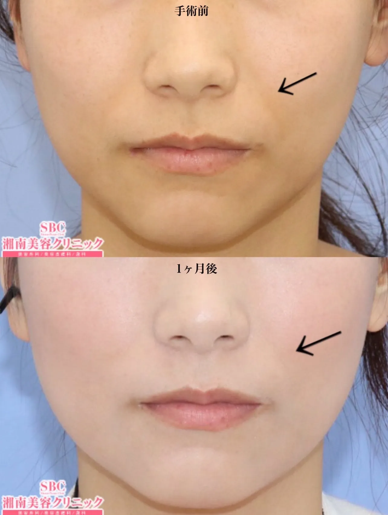 湘南美容クリニックの糸リフト症例②