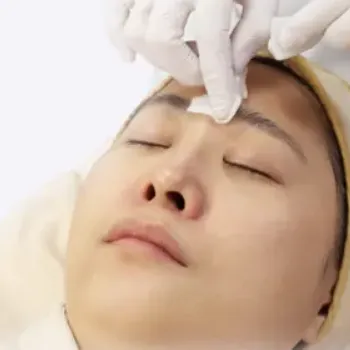 共立美容外科のケミカルピーリングのイメージ