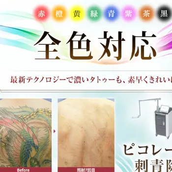 湘南美容クリニックの刺青除去のイメージ