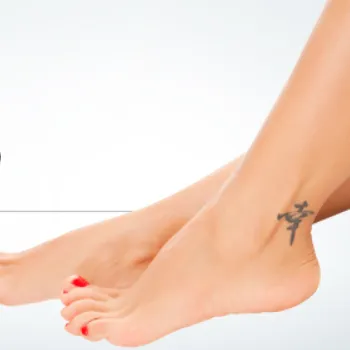 東京美容外科の刺青除去のイメージ