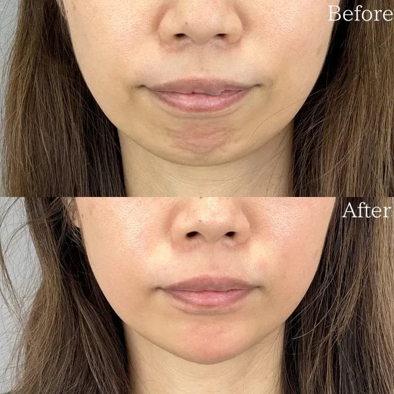 新潟でおすすめのヒアルロン酸注射症例写真