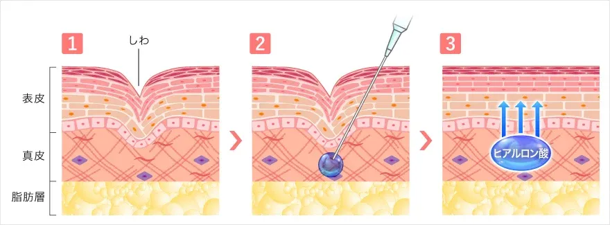 新潟でおすすめのヒアルロン酸注射皮膚断面図