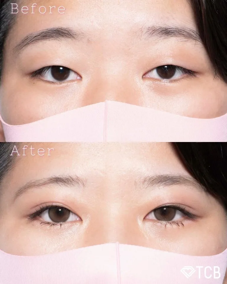 TCBの二重埋没の症例写真