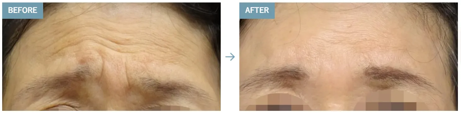 大阪でヒアルロン酸注射を受けられるおすすめのクリニックTCBのおでこ症例