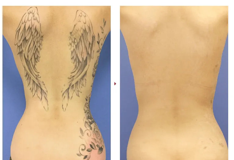 SBCのタトゥー除去(刺青除去)の症例写真