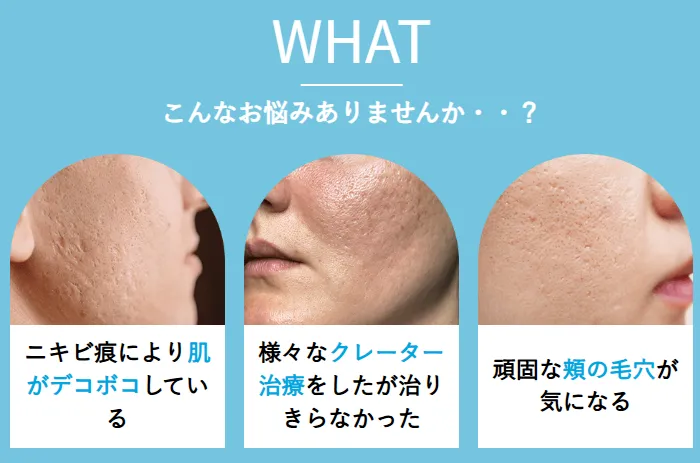 サブシジョンの特徴