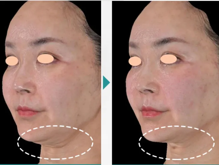 湘南美容クリニックのデンシティの症例