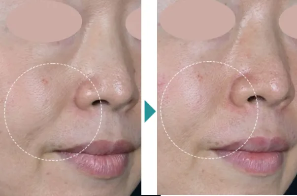 湘南美容クリニックのデンシティの症例