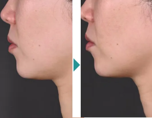 湘南美容クリニックのデンシティの症例