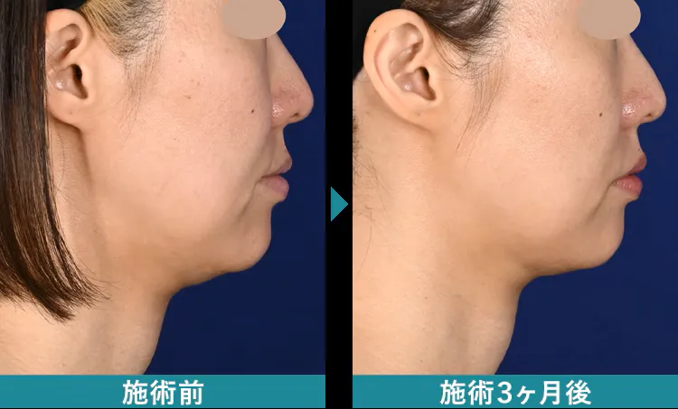 名古屋でデンシティが安いおすすめクリニック　湘南美容クリニック　症例写真