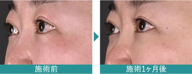 札幌 デンシティ 安い おすすめ 症例画像