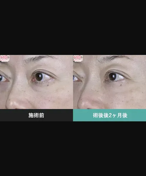 SBCのモフィウス8の症例