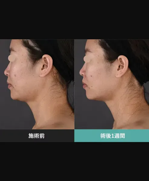 SBCのモフィウス8の症例