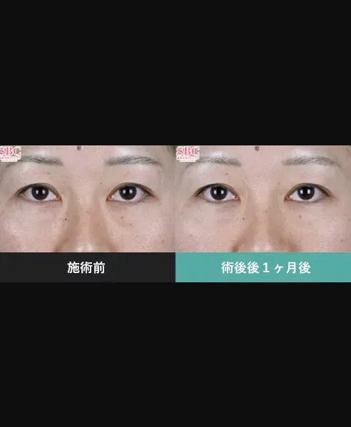 SBCのモフィウス8の症例