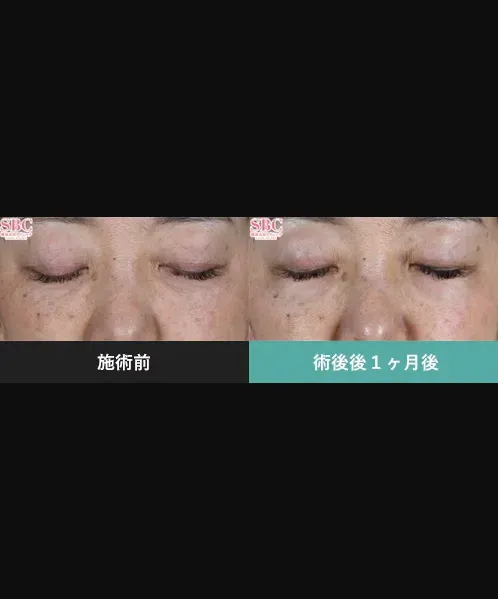 SBCのモフィウス8の症例