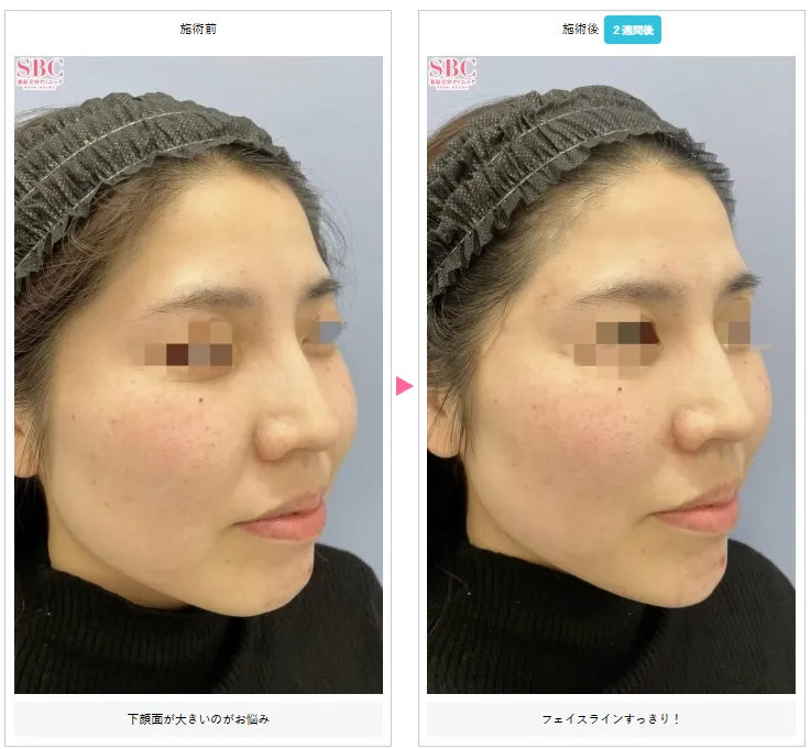 湘南美容外科でボトックスが上手な先生「宮崎恵子医師」の症例写真