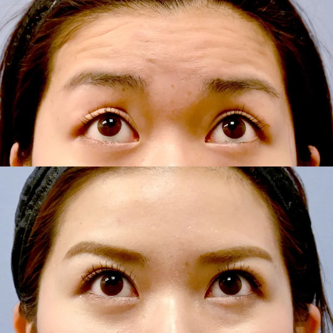 湘南美容外科でボトックスが上手な先生「池内理絵医師」の症例写真