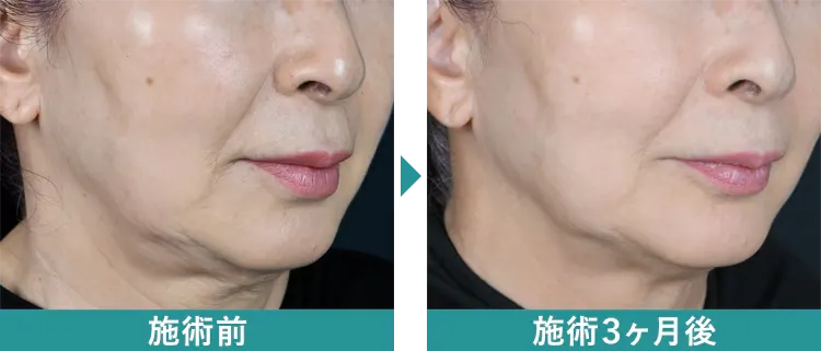 湘南美容クリニックのデンシティの症例写真