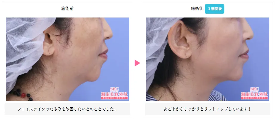 湘南美容クリニックの医療ハイフが上手い先生は? 症例写真⑦