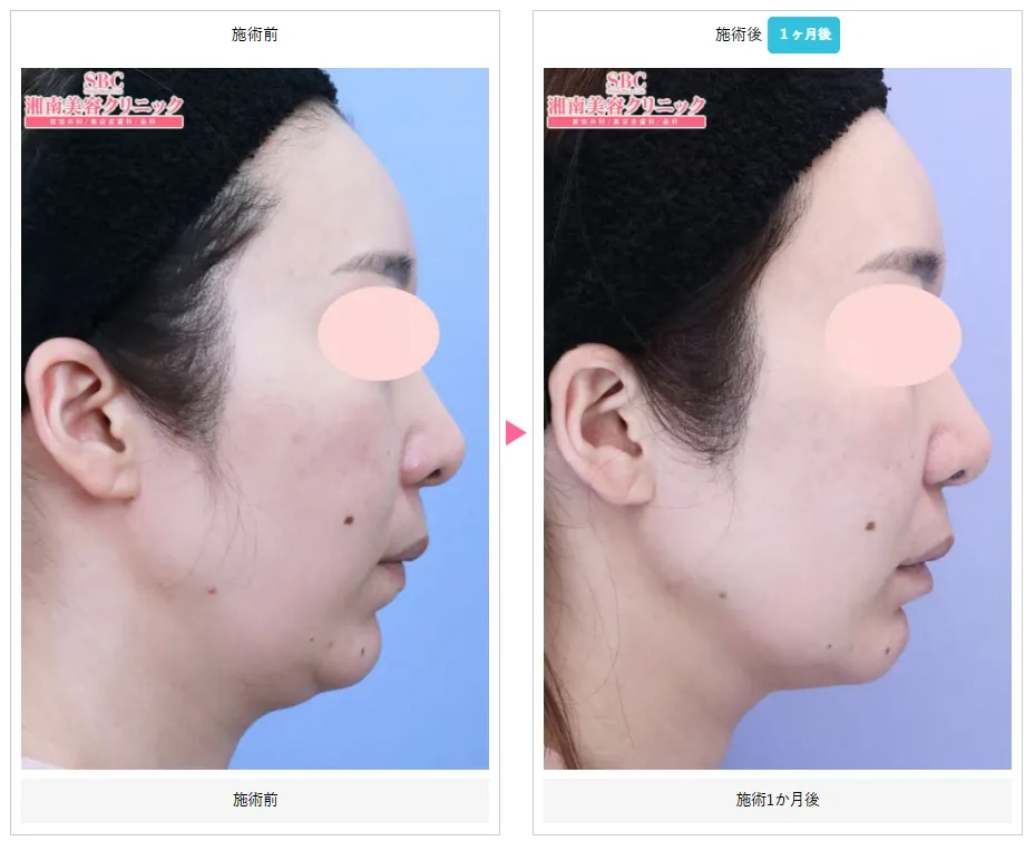 湘南美容クリニックの医療ハイフが上手い先生は? 症例写真④