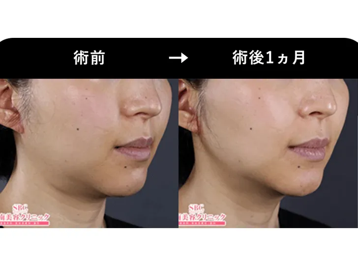 SBCの医療ハイフの症例