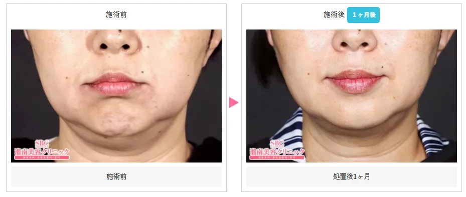 湘南美容クリニックの医療ハイフが上手い先生は? 症例写真③