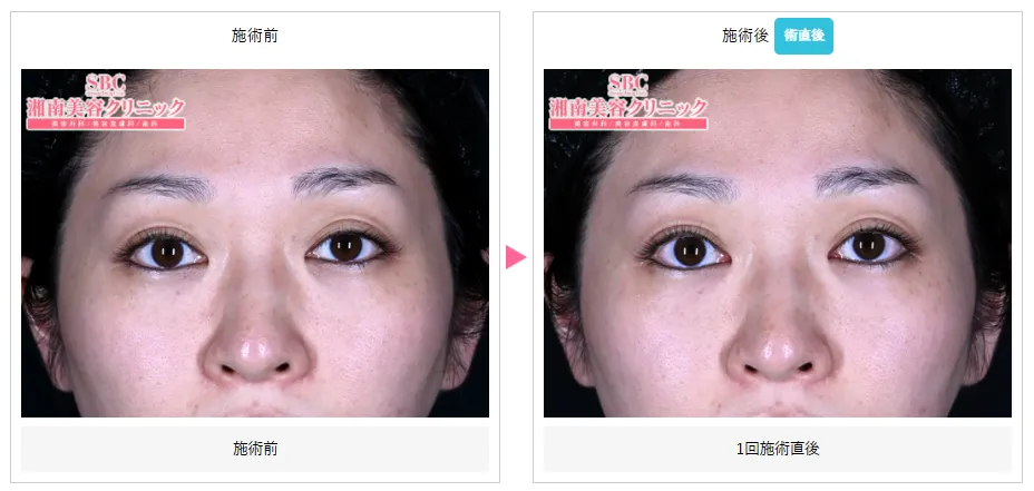 湘南美容クリニックの医療ハイフが上手い先生は? 症例写真②