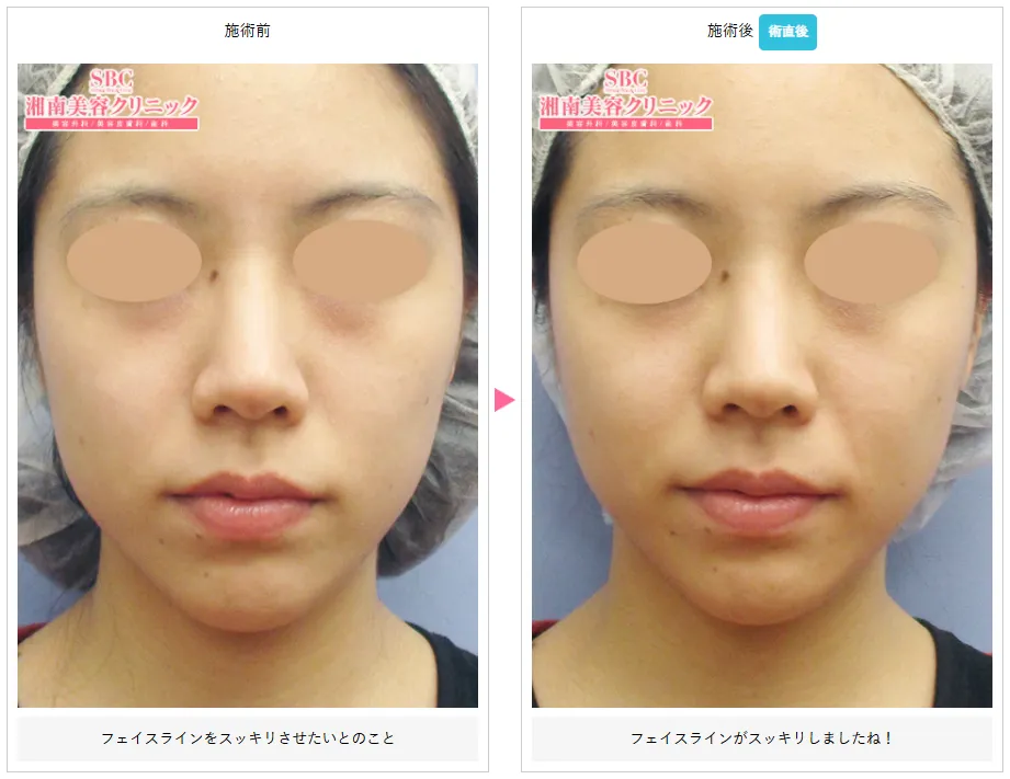 湘南美容クリニックの医療ハイフが上手い先生は? 症例写真⑥