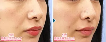 湘南美容クリニックのヒアルロン酸注入の知恵袋・口コミ評判 症例写真②