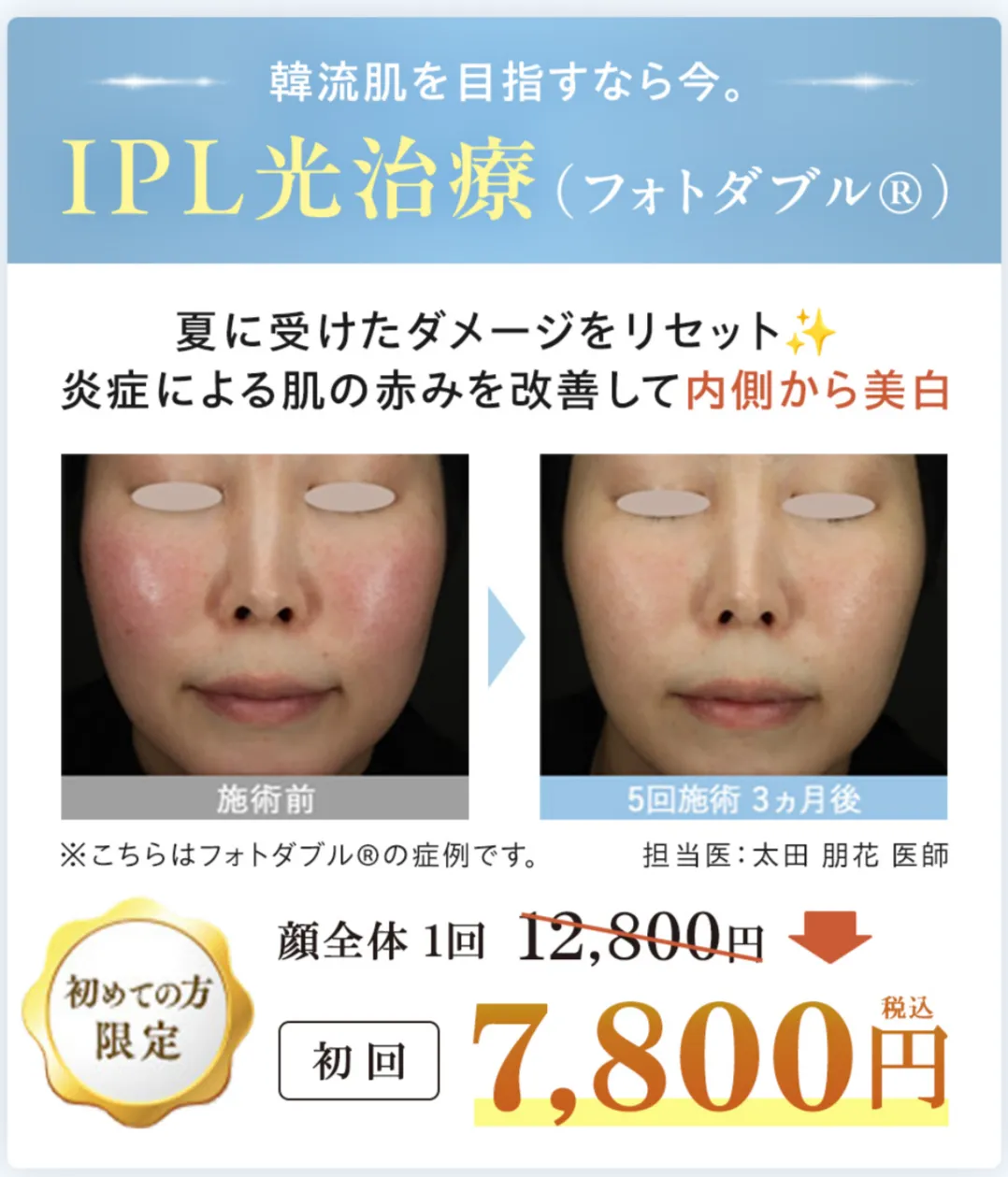 湘南美容クリニックのIPLは初回限定キャンペーンで7,800円
