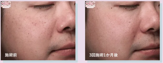 湘南美容クリニックのIPLの症例写真