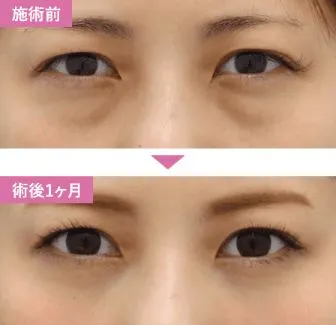 SBCのクマ取り(脱脂のみ)の症例