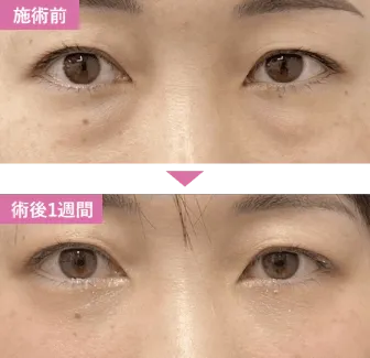 SBCのクマ取り(脱脂のみ)の症例