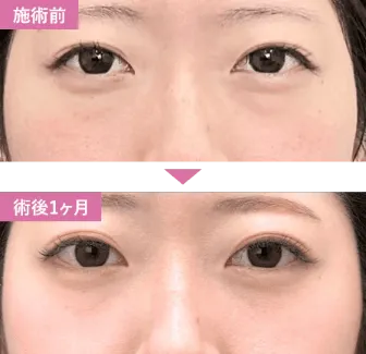 SBCのクマ取り(脱脂のみ)の症例