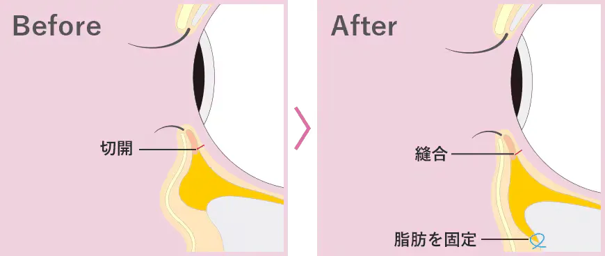 クマ取り施術の切開法