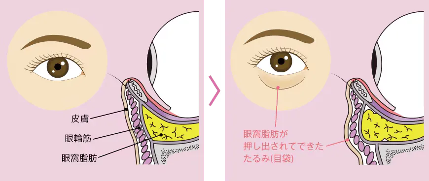 クマ取り施術の脱脂のみ