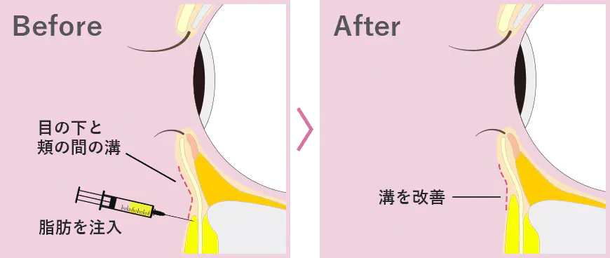 クマ取り施術の注入法