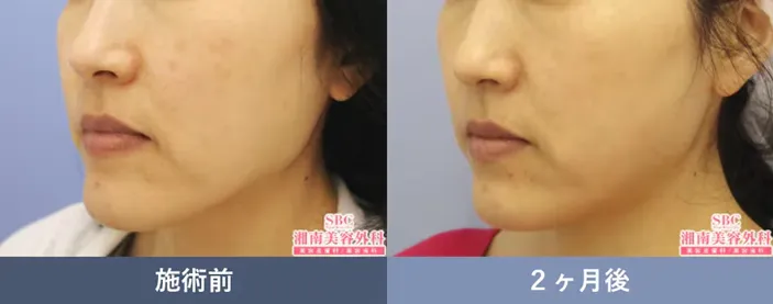 湘南美容クリニックのレーザートーニングの口コミ・ブログの評判 症例写真①