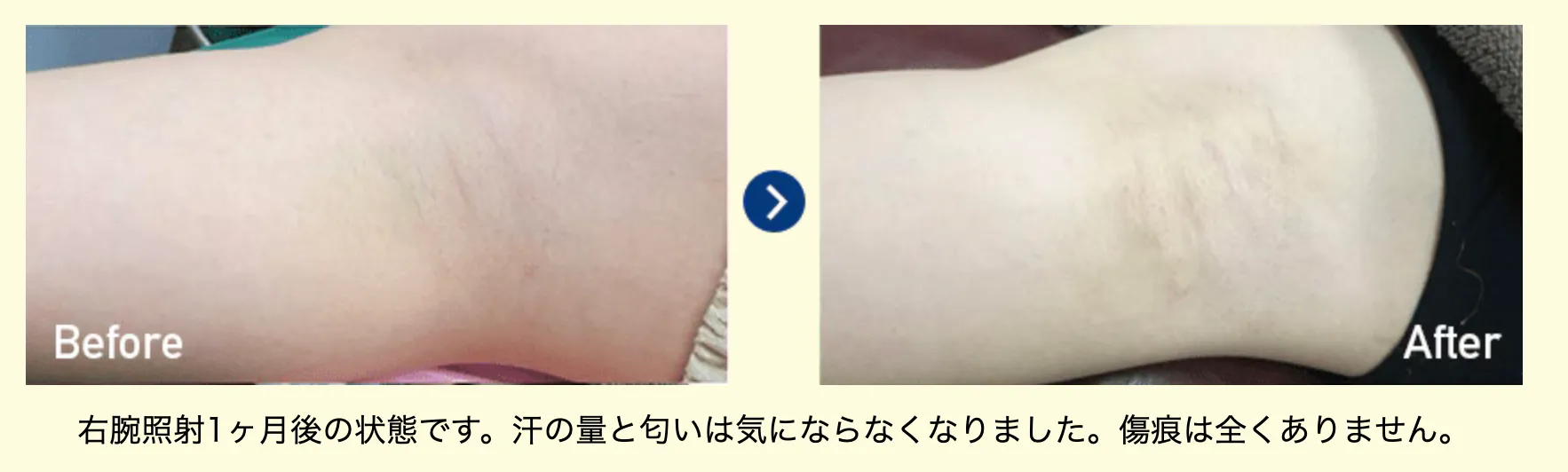 湘南美容クリニック ミラドライ 症例写真