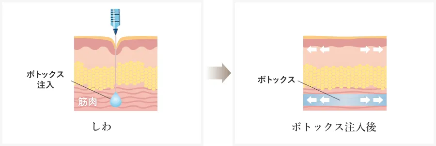 湘南美容クリニックのメンズシワ取り(ほうれい線)