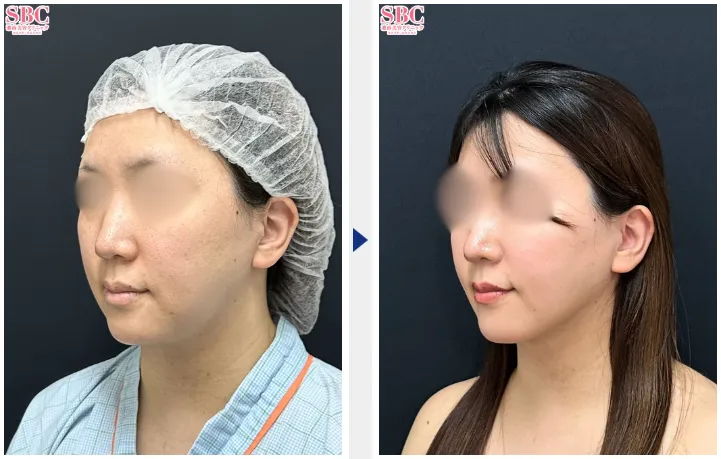湘南美容クリニック(旧:湘南美容外科)のメディカルサイズダウンの症例①