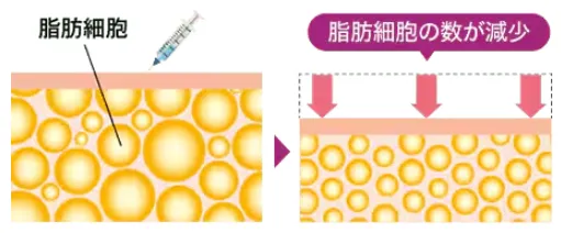 湘南美容クリニックのメディカルサイズダウンの脂肪溶解注射のイメージ