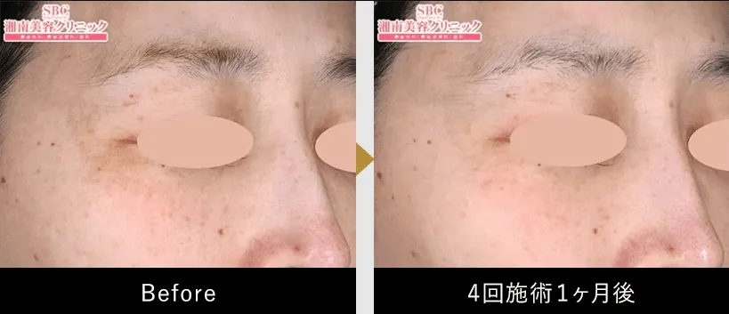 SBC症例写真2