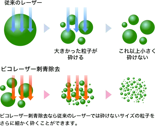 京都にある湘南美容クリニックの安いタトゥー除去(刺青除去) 従来のレーザーとピコレーザーの違い
