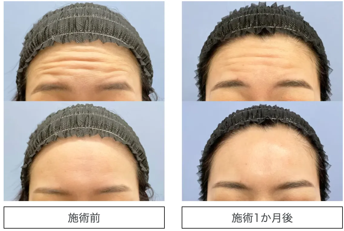 湘南美容クリニックのSBCトキシルスレッドの症例写真1