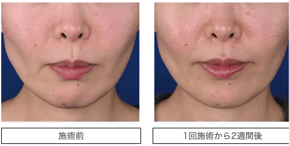 湘南美容クリニックのSBCトキシルスレッドの症例写真2