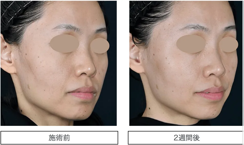 湘南美容クリニックのトキシルスレッドの症例写真3